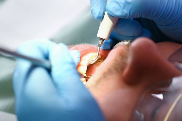 Best Emergency Treatment for Dental Infections or Abscesses in Sarasota Springs, FL