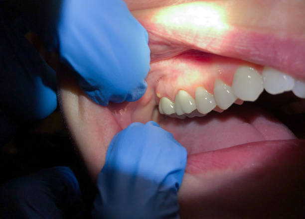 Best Emergency Treatment for Dental Infections or Abscesses in Sarasota Springs, FL
